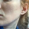 Nierówna skóra na twarzy - problem 