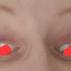 Blefaroplastyka  usunięto zbyt dużo skóry i tkanki tłuszczowej