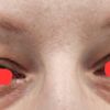 Blefaroplastyka  usunięto zbyt dużo skóry i tkanki tłuszczowej
