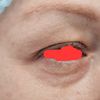Blefaroplastyka  usunięto zbyt dużo skóry i tkanki tłuszczowej