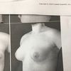 Powiększenie piersi a bardzo duża asymetria