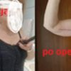 Plastyka obwisłych ramion