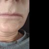 Zabieg powiększenia ust implantem
