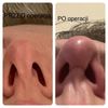 Nieudana operacja nosa - asymetria dziurek