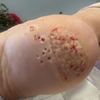 Laserowe usunięcie hpv na stopie