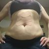 Czy abdominoplastyka jest u mnie wskazana? Polecanie specjaliści w Krakowie