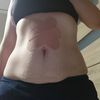 Czy abdominoplastyka jest u mnie wskazana? Polecanie specjaliści w Krakowie