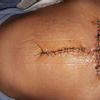 Blizny po abdominoplastyce ze zszyciem mięśni