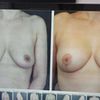 Fatalny biust pół roku po mastopeksji z założeniem implantów