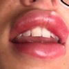 Dermfiller kwas hialuronowy na usta - ogromna opuchlizna