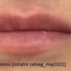 Krótkotrwały efekt powiększania ust kwasem hialuronowym