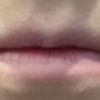 Krótkotrwały efekt powiększania ust kwasem hialuronowym