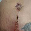 Abdominoplastyka - rana otwarta, czy to zakażenie? 