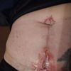 Abdominoplastyka - rana otwarta, czy to zakażenie? 
