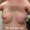 Efekt końcowy po powiększeniu piersi.