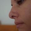 Nieudana operacja plastyczna nosa