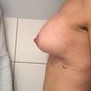 Implanty anatomiczne pod mięsień dziwny kształt piersi - nieudana operacja? 