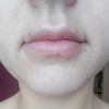 Załamanie skóry przy kącikach ust po kwasie hialuronowym StylAge M w usta