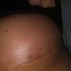 Blizny pod piersiami po powiększaniu piersi - jak wyglądają, jak je pielęgnować?