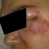 10-miesięczna BLIZNA PRZEROSŁA na twarzy - Jaka najlepsza metoda usunięcia/korek - 8941