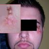 10-miesięczna BLIZNA PRZEROSŁA na twarzy - Jaka najlepsza metoda usunięcia/korek - 8942