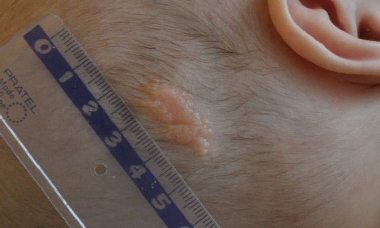Bliznowiec na główce 5-miesięcznego dziecka - 8945