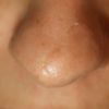  Usunięcie blizny nosa, rozcięcie zszyto jak zwykły szew a nie szew kosmetyczny - 8973