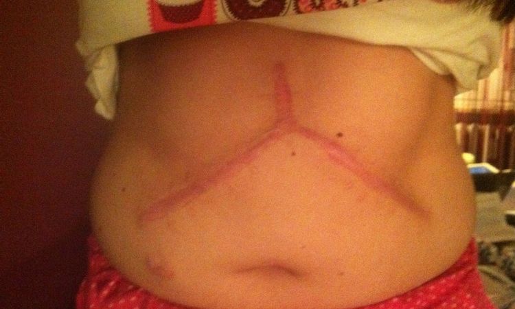Głęboka i rozległa blizna po resekcji wątroby - 8981