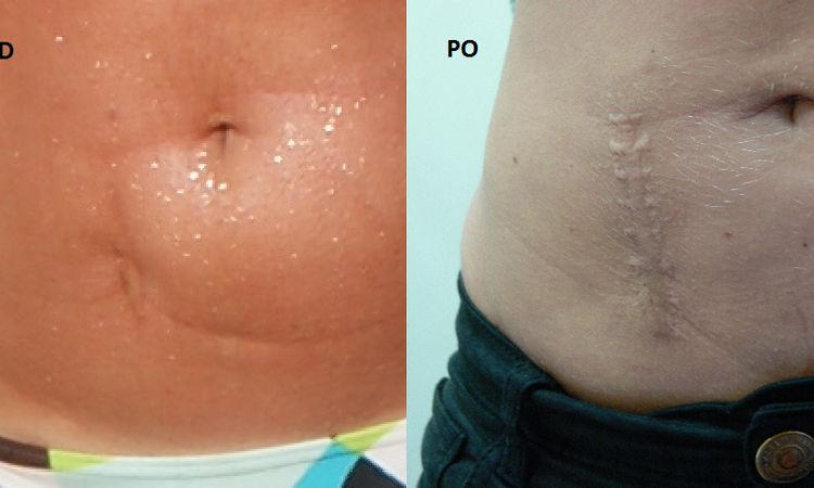 Zwiotczenie skóry po liposukcji oraz przerost blizny pooperacyjnej z dzieciństwa - 9066