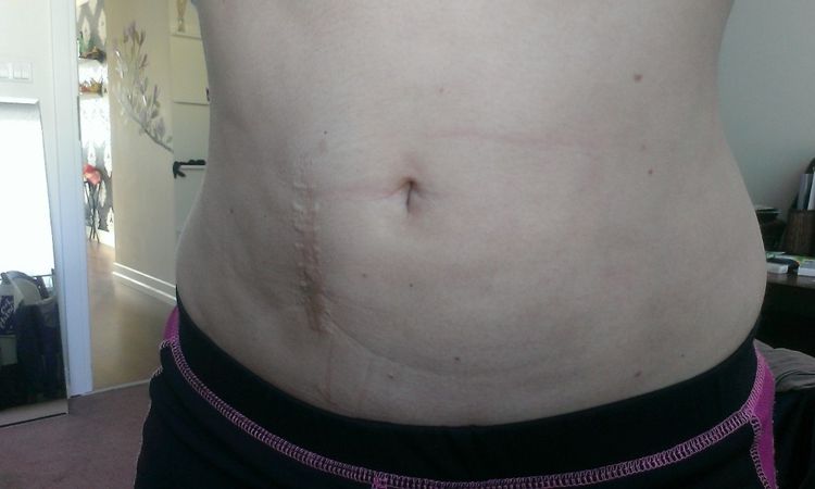 Zwiotczenie skóry po liposukcji oraz przerost blizny pooperacyjnej z dzieciństwa - 9067