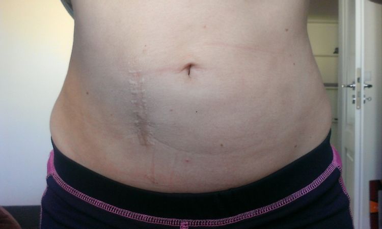 Zwiotczenie skóry po liposukcji oraz przerost blizny pooperacyjnej z dzieciństwa - 9068