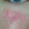 Komplikacje po dermabrazji laserowej - jak dbać o podrażnienia