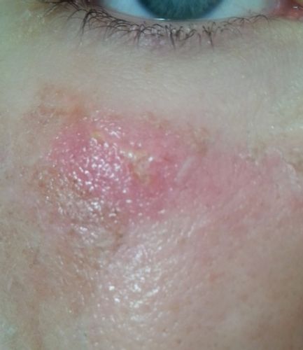 Komplikacje po dermabrazji laserowej - jak dbać o podrażnienia