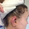 Korekta uszu - niezadowolenie z efektu - 9116