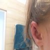 Korekta uszu - niezadowolenie z efektu - 9118