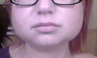 Opuchlizna po lipolizie iniekcyjnej 