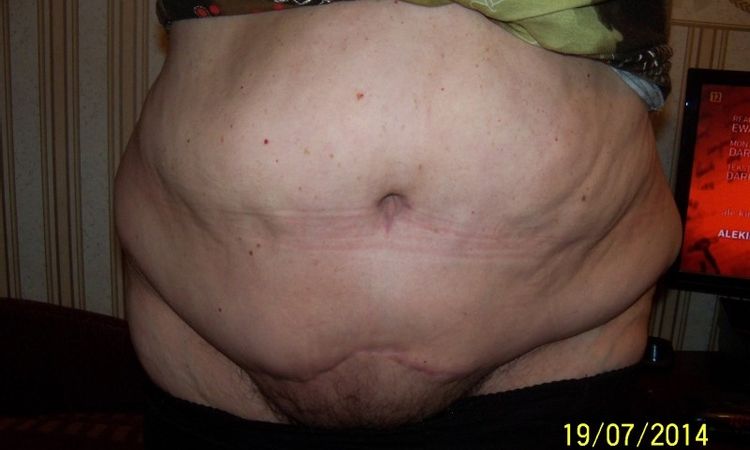 Nieudana abdominoplastyka w Łodzi - co robić? - 9205