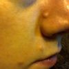 Zmiany skórne na nosie i twarzy - metody usunięcia - 9237
