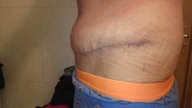 Obrzęk 2 tygodnie po plastyce brzucha - 9325