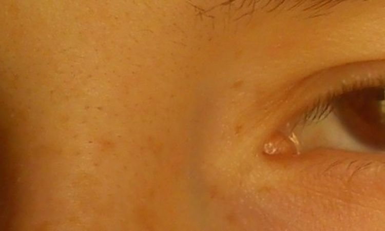 Blepharoplastyka w młodym wieku - czy jest odpowiednia? - 9382