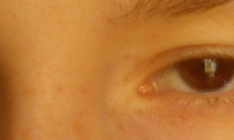 Blepharoplastyka w młodym wieku - czy jest odpowiednia? - 9384