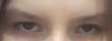 Blepharoplastyka w młodym wieku - czy jest odpowiednia? - 9386