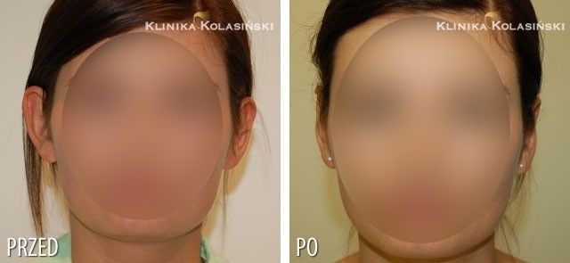 Niezadowolenie z korekcji uszu - jakie efekty można osiągnąć? - 9394