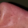 Garbaty nos po operacji - opuchlizna - kiedy możliwa reoperacja? - 9468