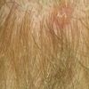 Usuwanie 'pieprzyka' z owłosionej skóry głowy - blizna  - 9499