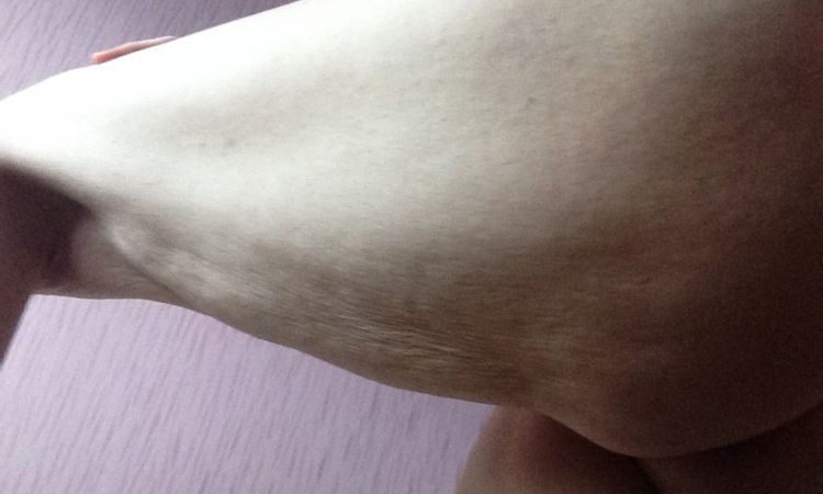 Cellulit, rozstępy, obwisła skóra i nadmiar tkanki tłuszczowej - 9532