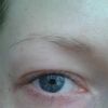 Jakie metody wybrać do poprawy wyglądu okolic oczy w takim przypadku? - 9705