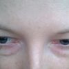 Jakie metody wybrać do poprawy wyglądu okolic oczy w takim przypadku? - 9707