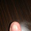 Problem z paznokciami na kciukach - 9709