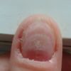 Problem z paznokciami na kciukach - 9711